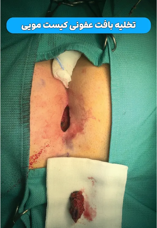 تخلیه بافت عفونی بعد کیست مویی
