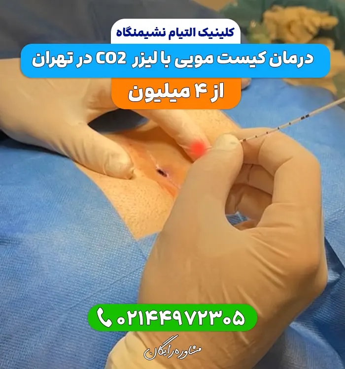عمل کیست مویی با لیزر در تهران