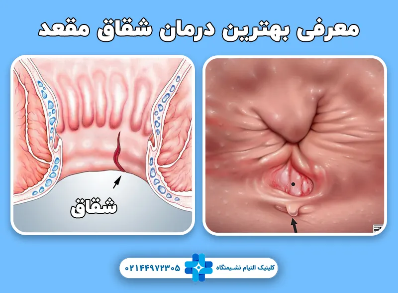 هترین شیوه درمان شقاق