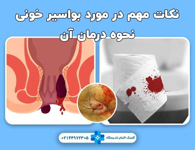 بواسیر خونی و نحوه درمان آن