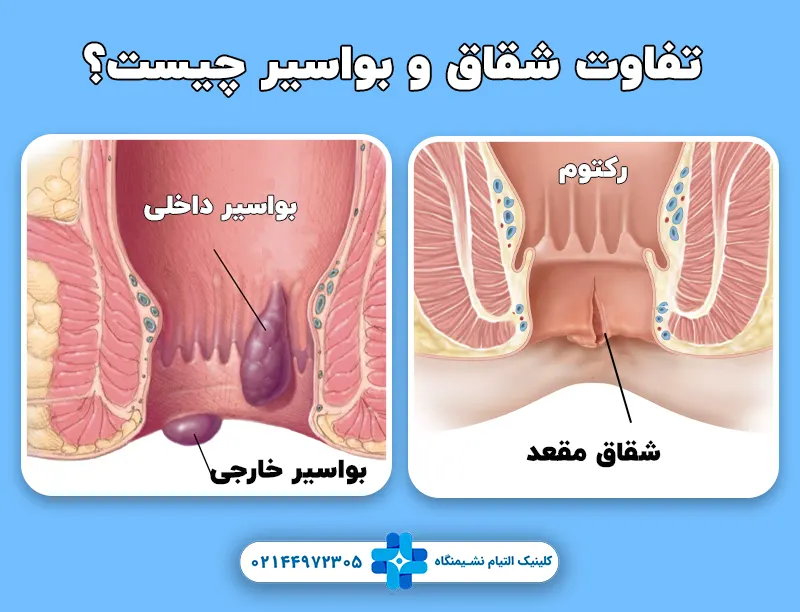 تفاوت شقاق و بواسیر چیست؟