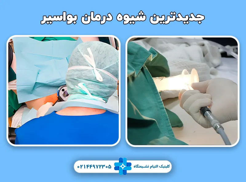 جدیدترین روش درمان بواسیر