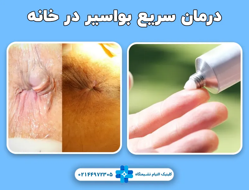 درمان بواسیر در خانه