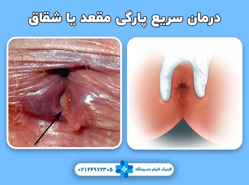 درمان سریع پارگی مقعد
