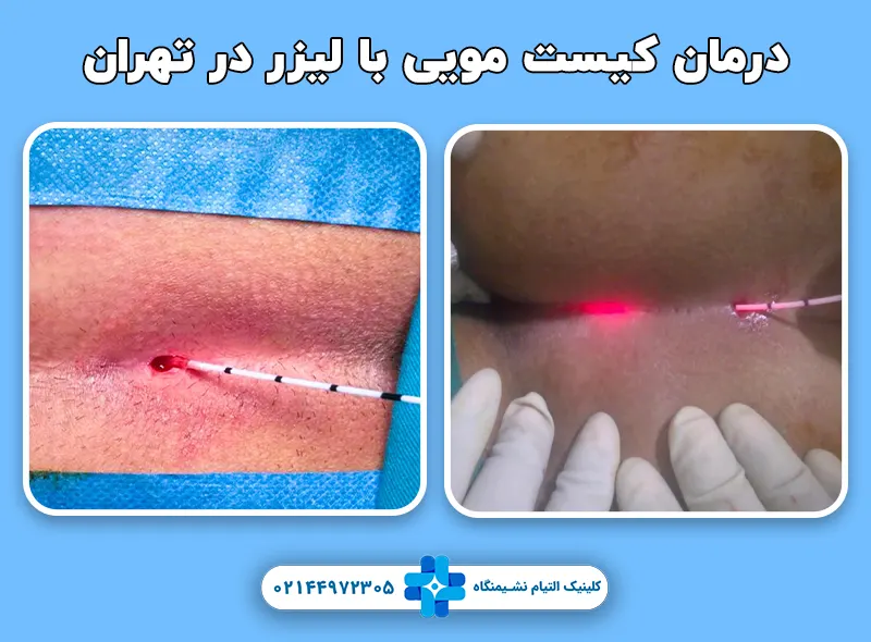 درمان کیست موی با لیزر