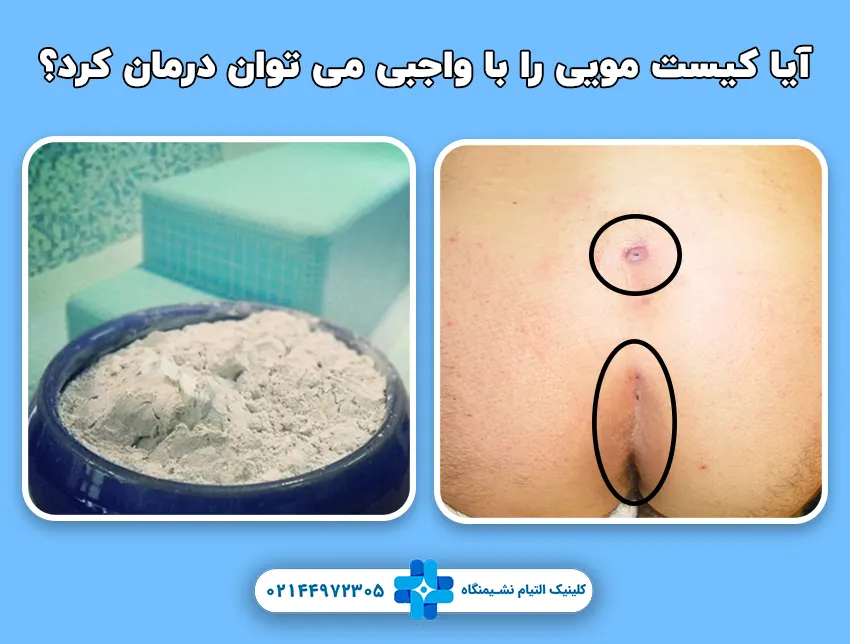 آیا کیست مویی را با واجبی می توان درمان کرد؟