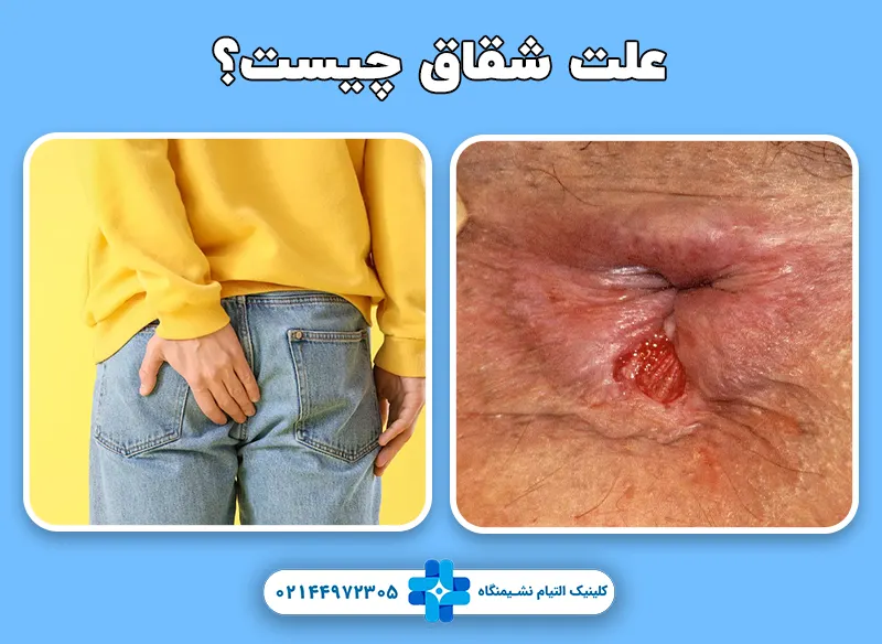 علت شقاق مقعدی