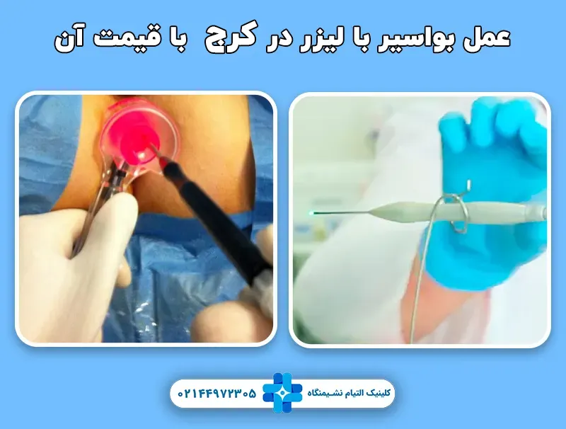 عمل بواسیر با لیزر در کرج