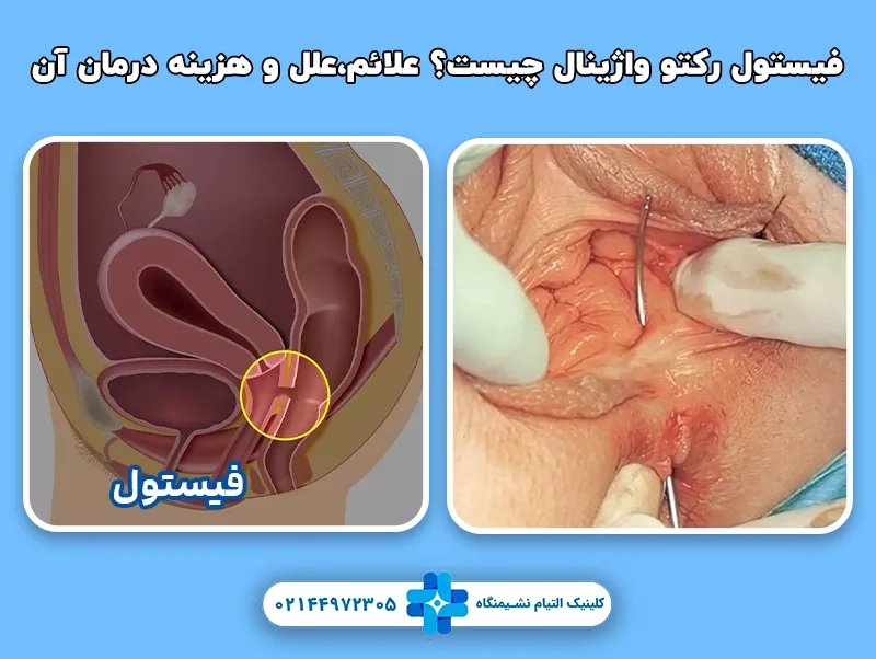 فیستول رکتوواژینال