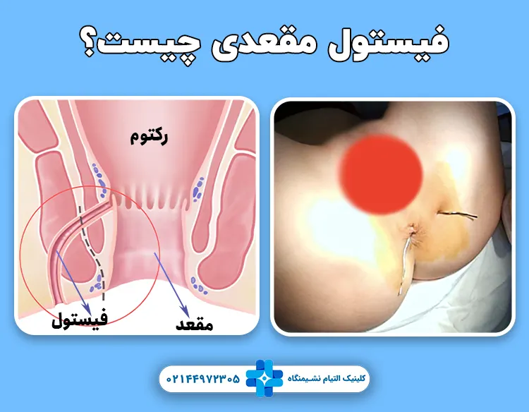 فیستول مقعد