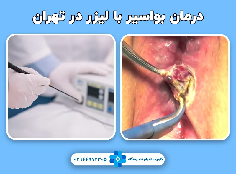 لیزر بواسیر تهران