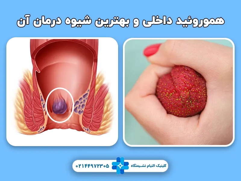 هموروئید داخلی و بهترین شیوه درمان آن