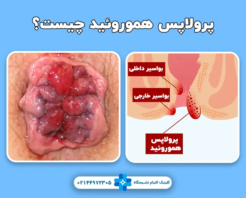 پرولاپس هموروئید