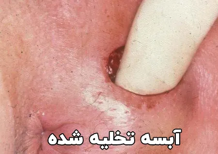 آبسه تخلیه شده