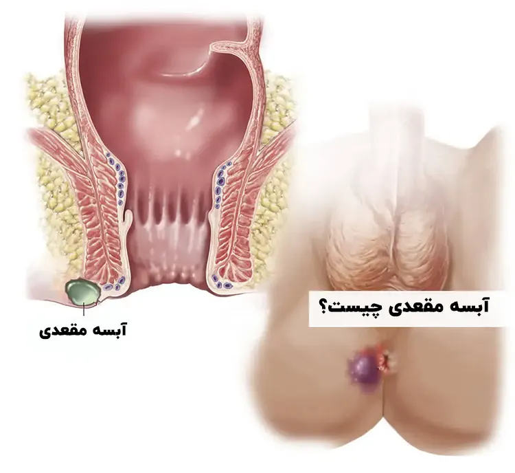 آبسه مقعدی