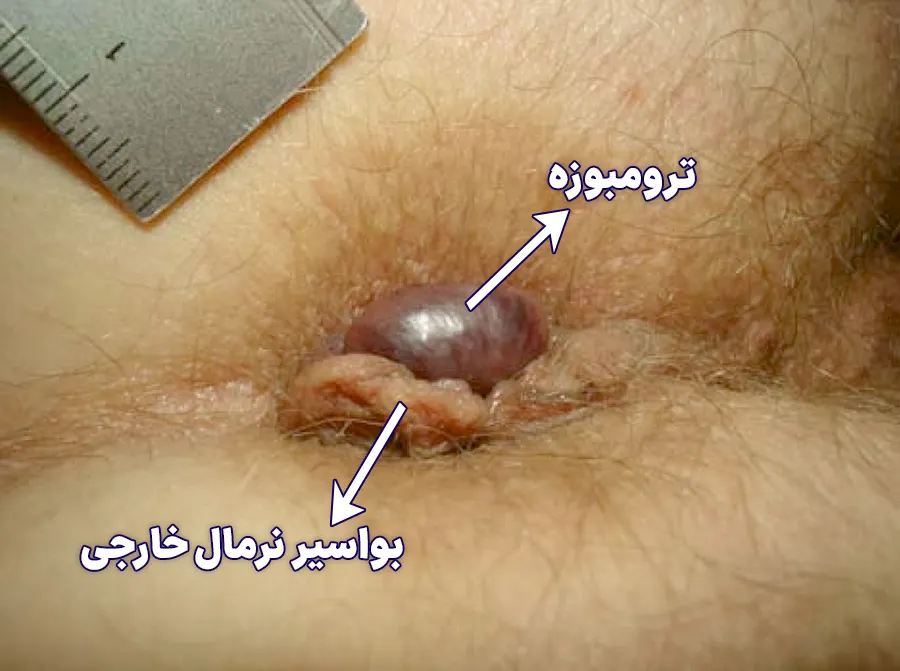 انواع هموروئید