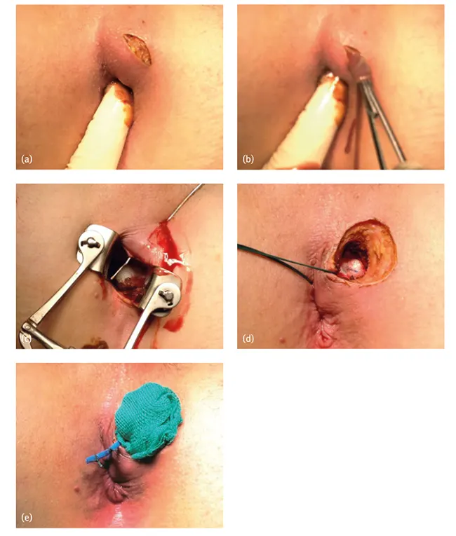 تخلیه آبسه مقعدی