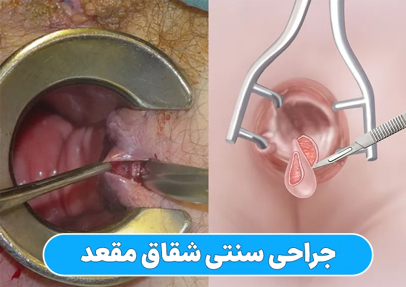 جراحی سنتی شقاق مقعد