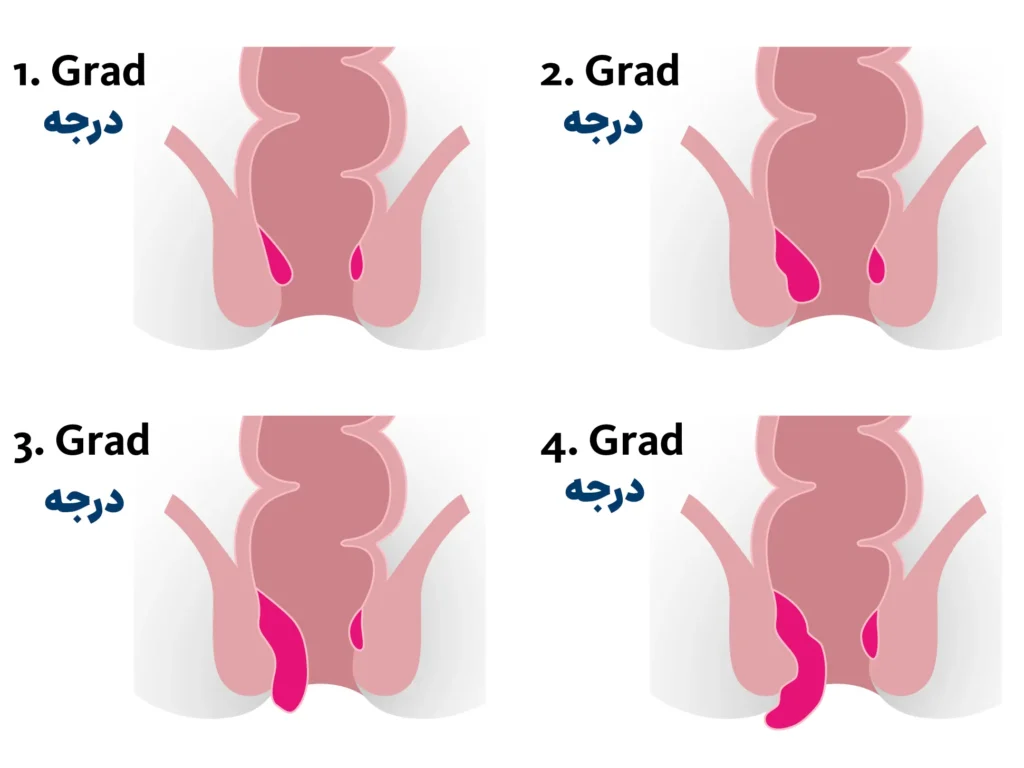 درجه بواسیر