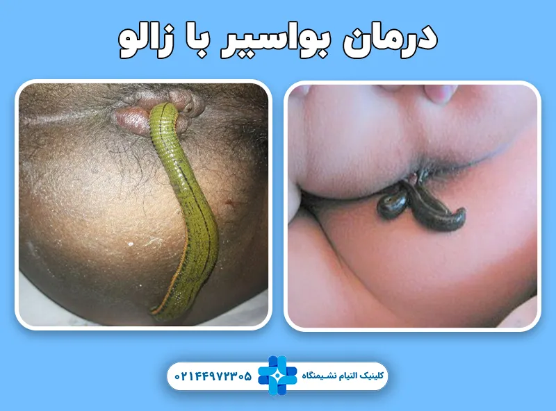 درمان بواسیر با زالو