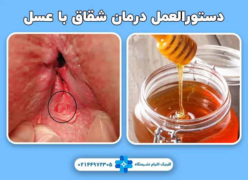 درمان شقاق با عسل