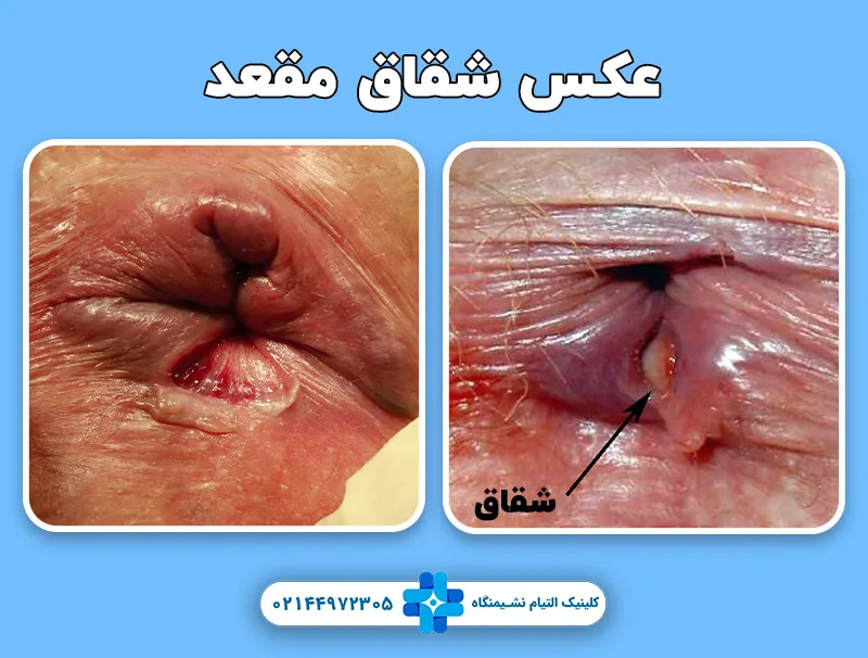 عکس شقاق مقعد