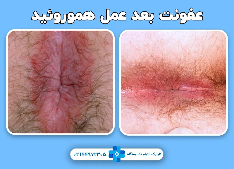 عفونت بعد عمل بواسیر