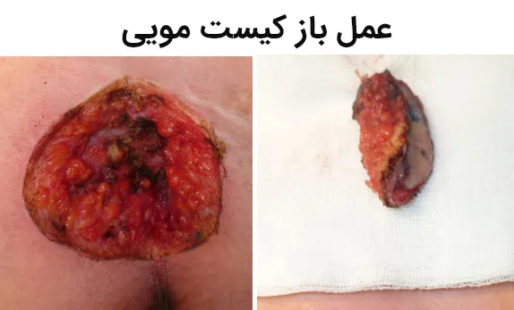 عمل باز کیست مویی