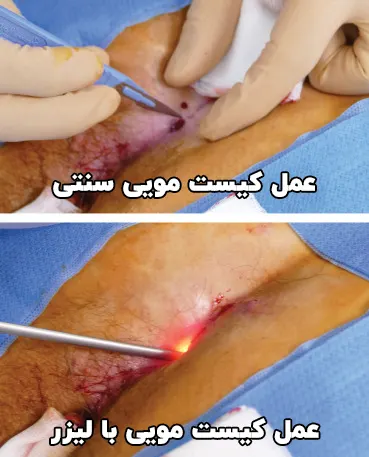 عمل کیست مویی