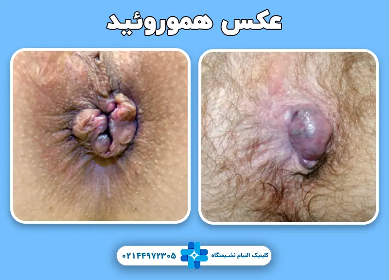 عکس هموروئید