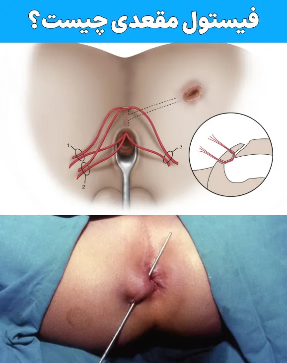 فیستول مقعدی چیست