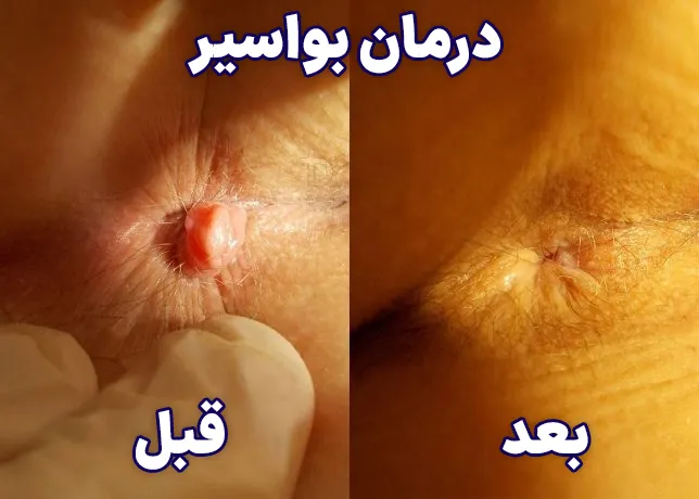 قبل بعد درمان بواسیر