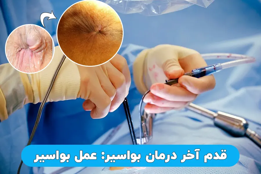 قدم آخر درمان بواسیر عمل بواسیر
