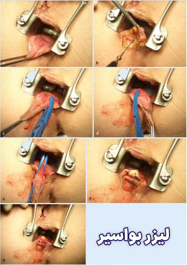 لیزر بواسیر