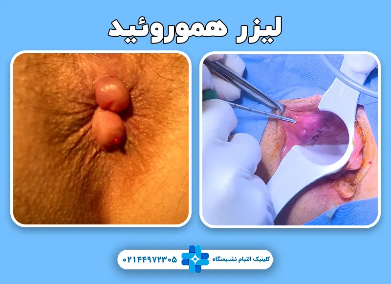 لیزر هموورئید