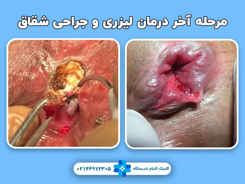 مرحله آخر درمان لیزری و جراحی شقاق