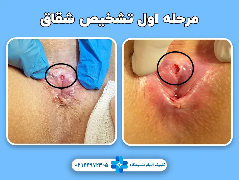 مرحله اول تشخیص شقاق