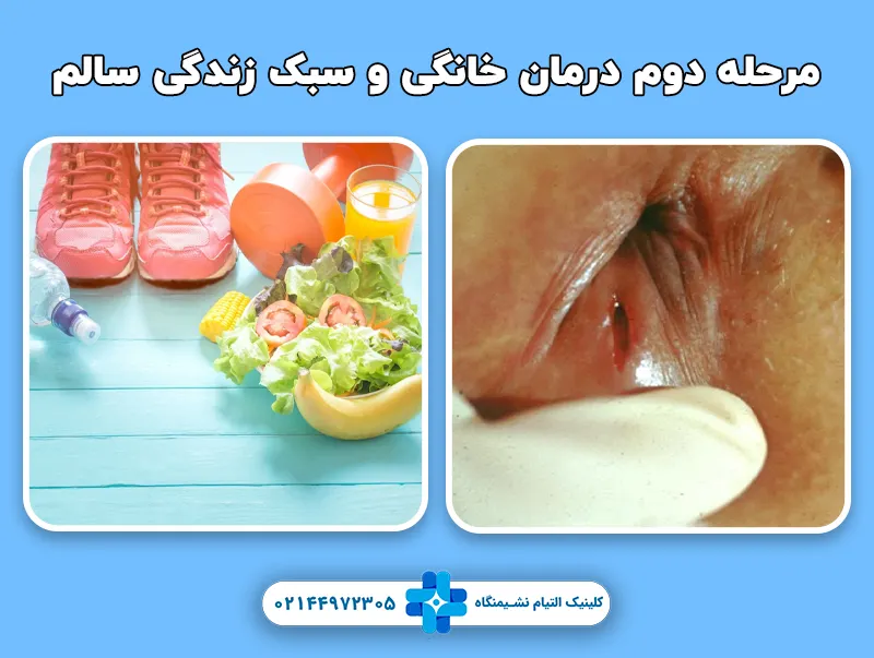 مرحله دوم درمان خانگی و سبک زندگی سالم