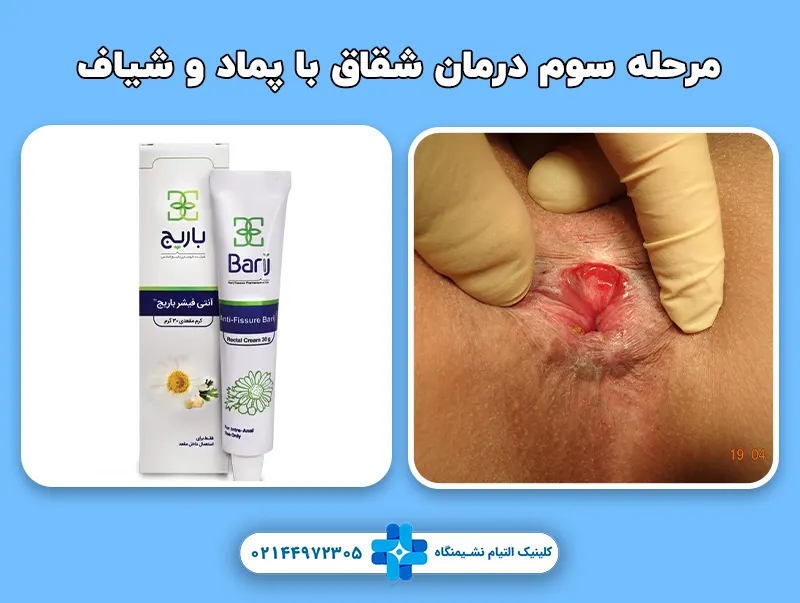 مرحله سوم درمان شقاق با پماد و شیاف