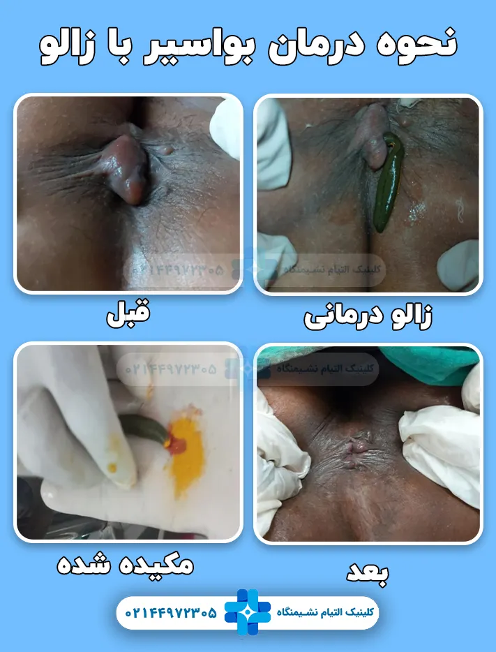 نحوه درمان بواسیر با زالو