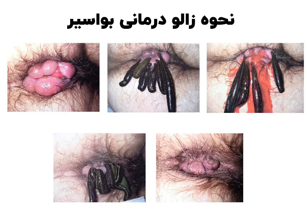 نحوه زالو درمانی بواسیر