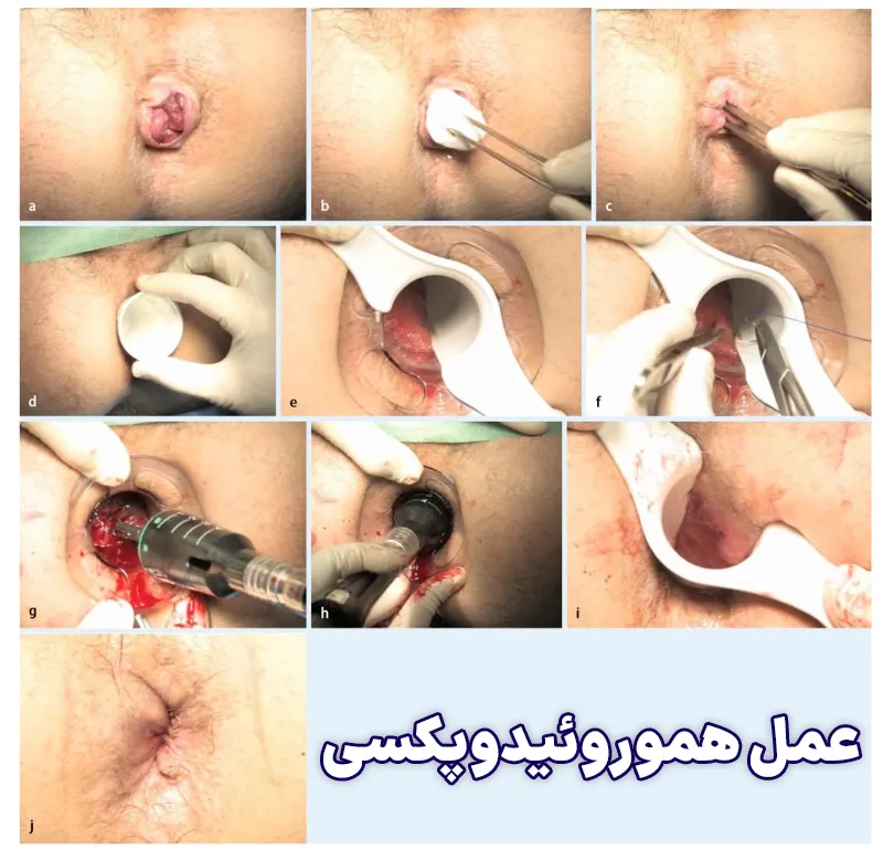 هموروئیدوپکسی