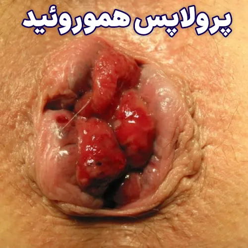 پرولاپس هموروئید