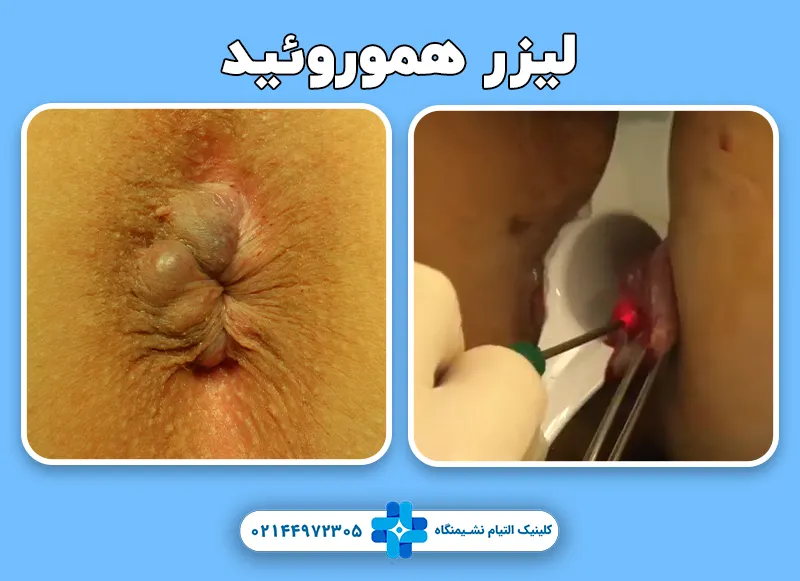لیزر هموورئید