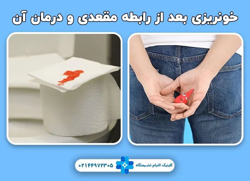 خونریزی بعد از رابطه مقعدی و درمان آن