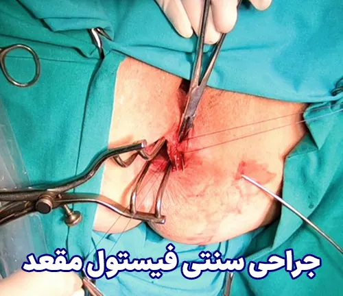 جراحی سنتی فیستول مقعد