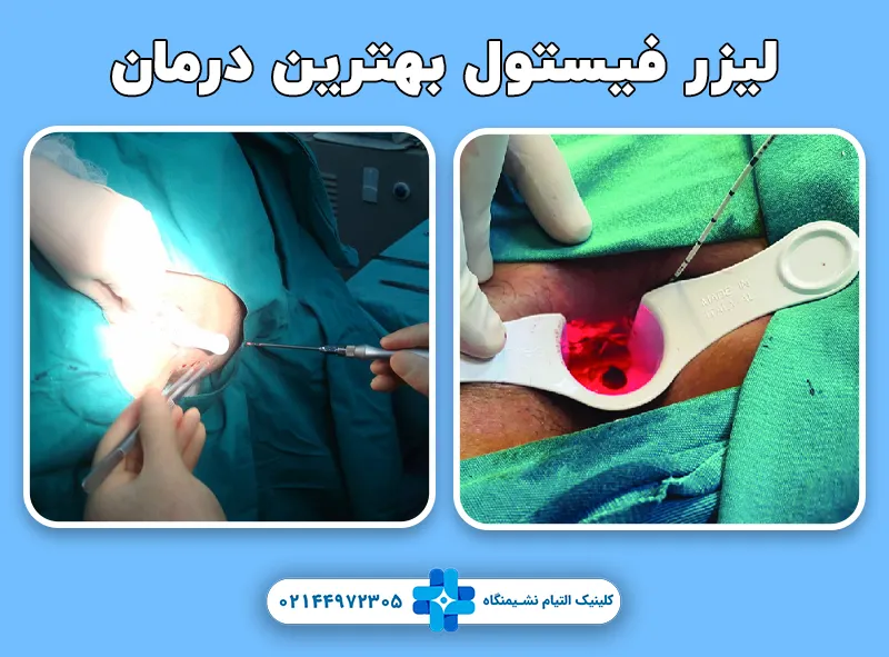 درمان فیستول مقعد با لیزر