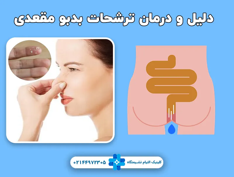 ترشحات مقعدی و درمان آن