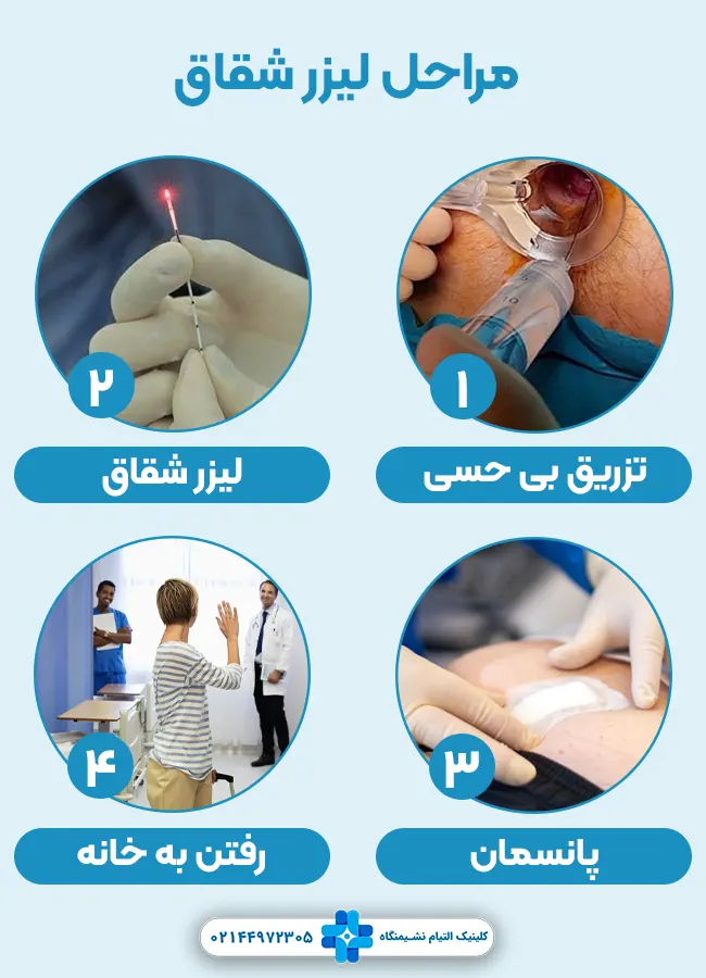 مراحل لیزر شقاق مقعد