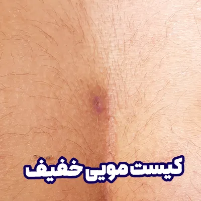 کیست مویی خفیف